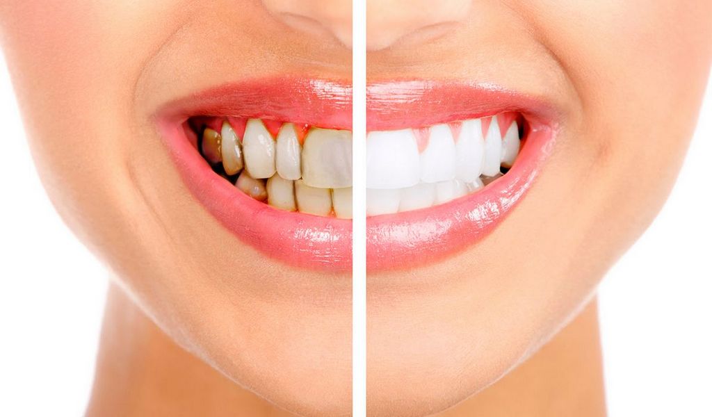 Удаление зубного камня: Как сохранить зубы чистыми и здоровыми